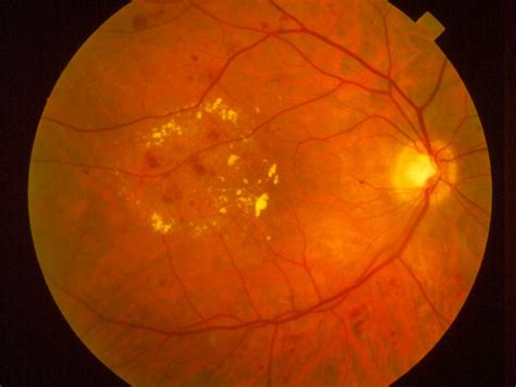 rockland diabetic retinopathy